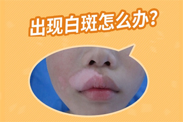 手上白癜風可以治嗎